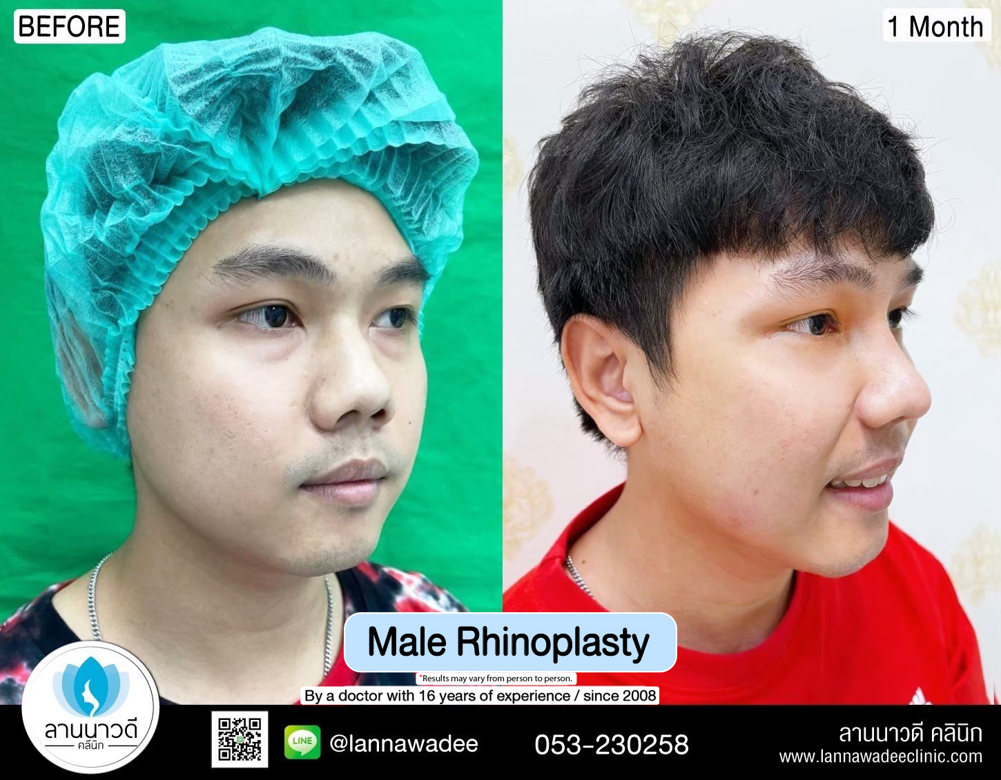 Male Rhinoplasty